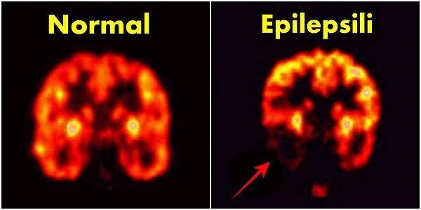 Epilepsi ve Ketojenik Diyet ile Beslenme Tedavisi