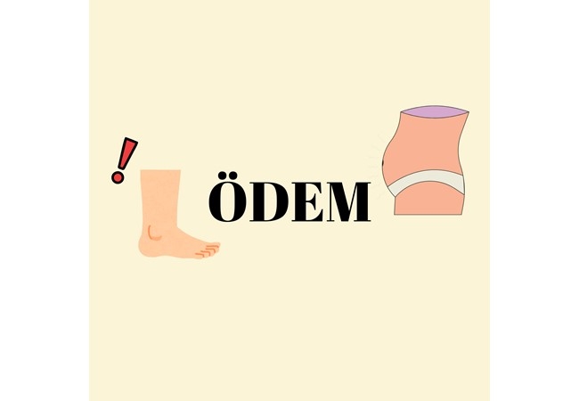 ÖDEM NEDİR? BESLENMEYLE ÖDEM NASIL AZALTILABİLİR?