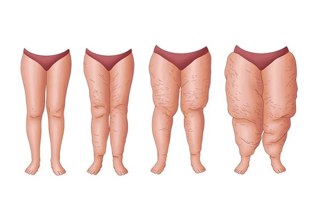 SELÜLİT Mİ ? LİPÖDEM Mİ ? LİPÖDEM HASTASI OLABİLİRSİNİZ !